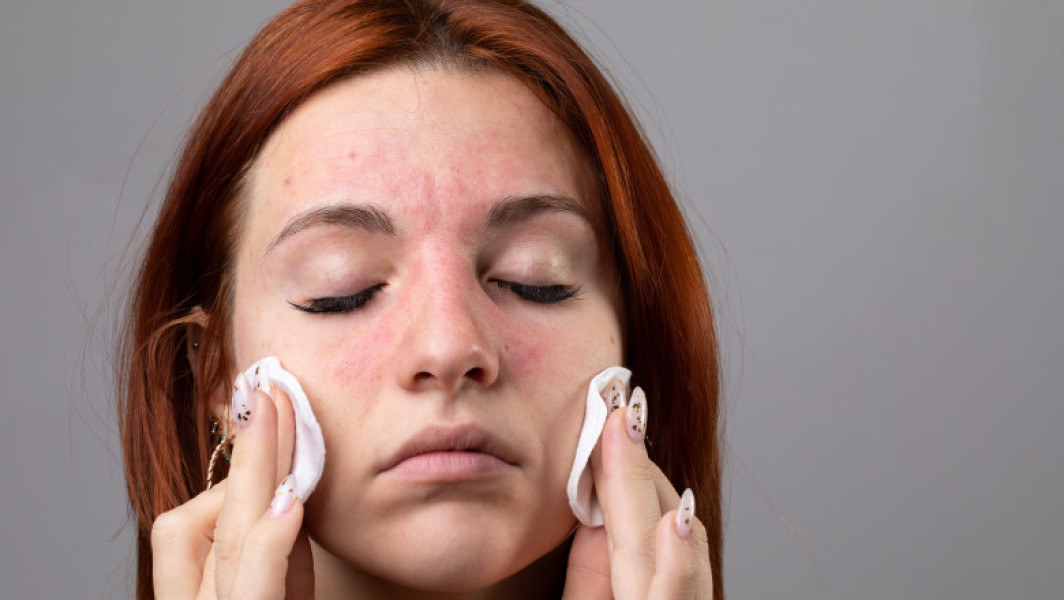 Alergia la frig: simptome, cauze și tratamente