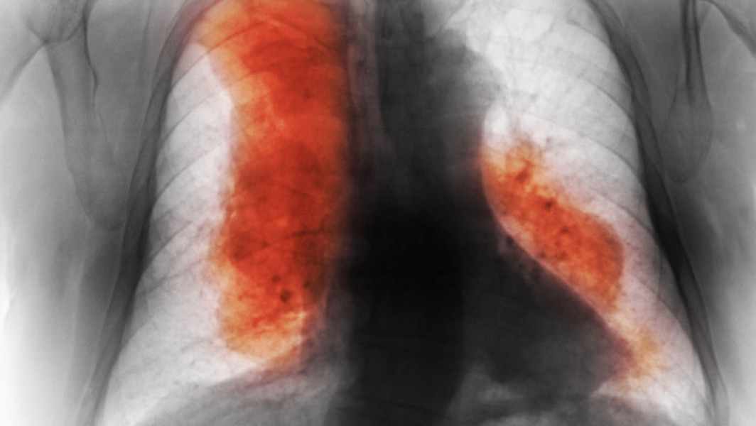Decesele cauzate de cancer ar putea depăși 18,5 milioane anual până în 2050
